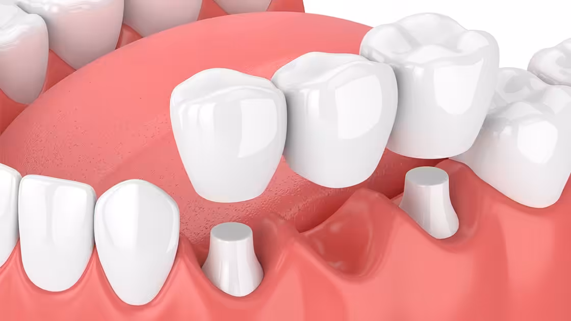 Dental Bridge